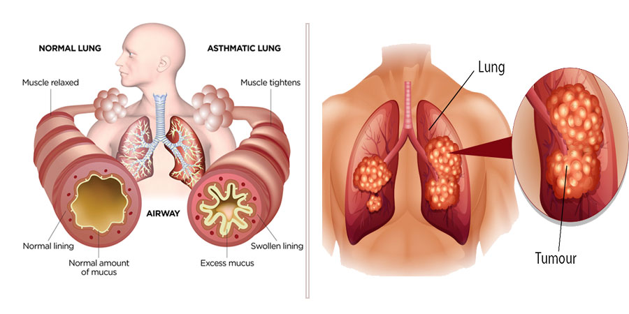 Lung Cancer Causes, Prevention, Symptoms