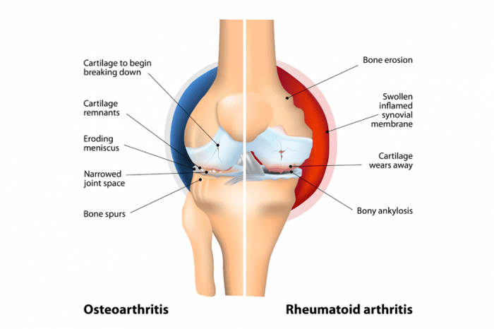 comparison-of-osteoarthritis-and-rheumatoid-arthritis