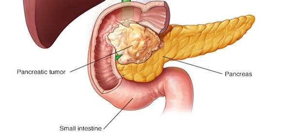 Pancreatic Cancer